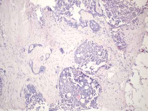 Ewa Chmielik Rycina 19. Rak brodawkowaty lity, biopsja gruboigłowa Rycina 20. Rak brodawkowaty lity in situ, materiał operacyjny Rycina 21.