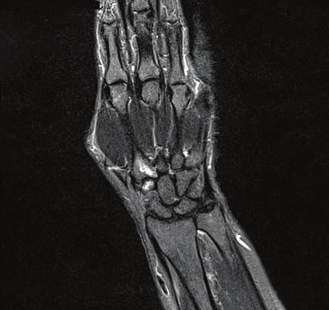 Thickening and increased vascularity of the synovial membrane (synovitis) in the suprapatellar recess of the knee joint in US exam (anty -CCP), kolagenom, ludzkiej glikoproteinie HC -gp39 i białku