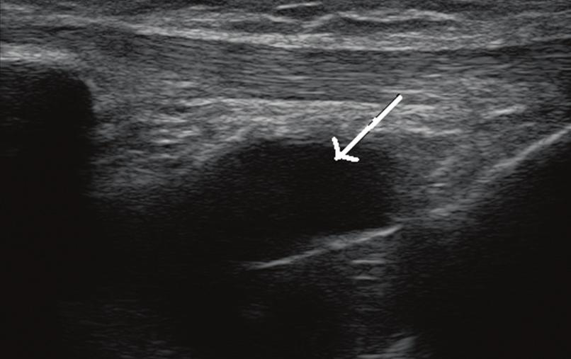 arwienie błękitem alcjanu, hodowla 21-dniowa Fig. 3. Chondrogenesis of intraarticular adipose-derived mesenchymal stem cells is efficient in O samples.