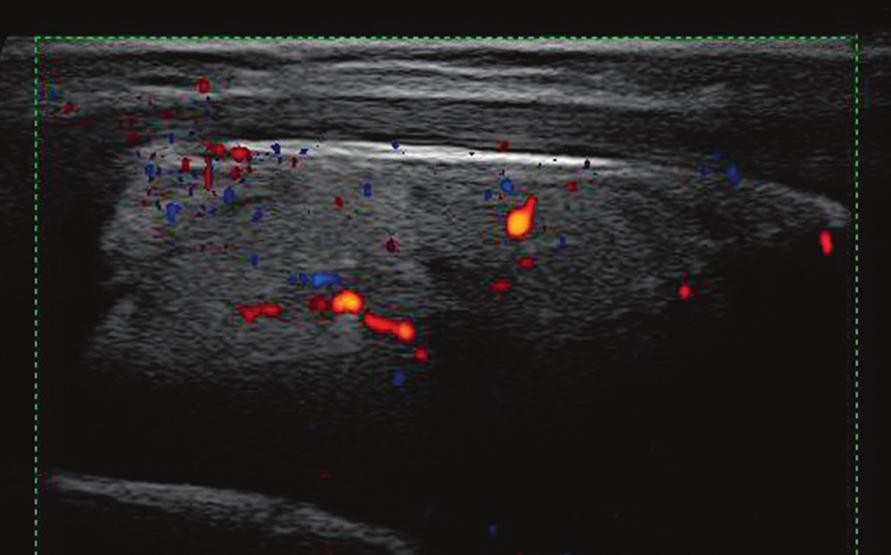 Role of inﬂammatory factors and adipose p tissue in p pathogenesis g of rheumatoid arthritis and osteoarthritis. Ryc. 5. Hiperechogeniczny, z cechami unaczynienia tłuszcz IPFP.