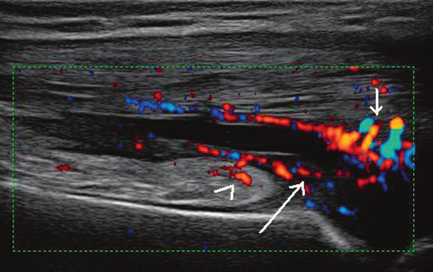 (długa strzałka) również z cechami unaczynienia w badaniu dopplerem mocy Fig. 5. Hyperechoic IPFP with features of vascularity.