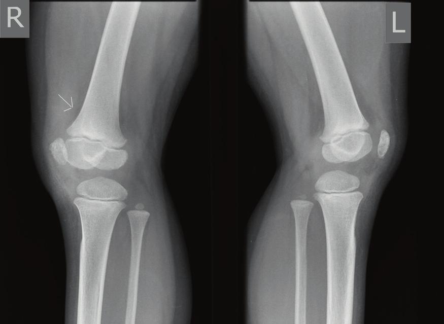 synovitis (long arrow) also with the features of vascularity in power Doppler scan Ryc. 6. Pacjent z RZS:.
