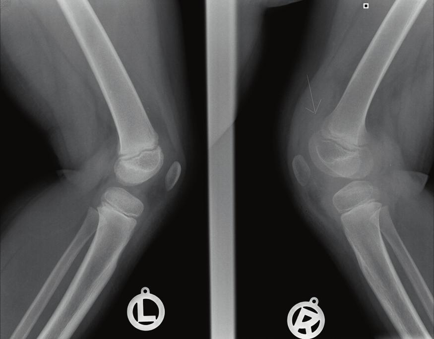 shadowing of the suprapatellar recess of the right knee in X-ray (arrow);.