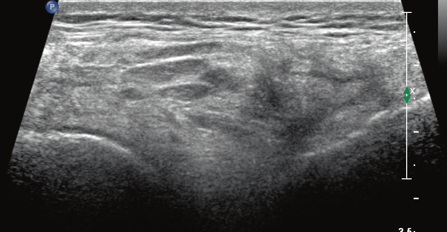 Considerably thickened and hyperechoic adipose tissue:. of the Hoffa s fat pad and. located superficially in relation to the quadriceps tendon/in paratenon (arrows) Ryc. 9.