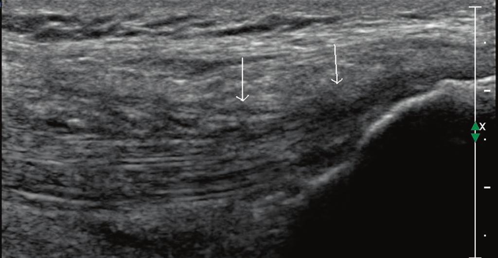 Tenosynovitis () as well as edema and hyperemia of the periarticular adipose tissue () of the fibular tendons compartment at the ankle Ryc. 10.