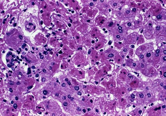 AlAT i AspAT świadczą o uszkodzeniu hepatocytów, a nie o