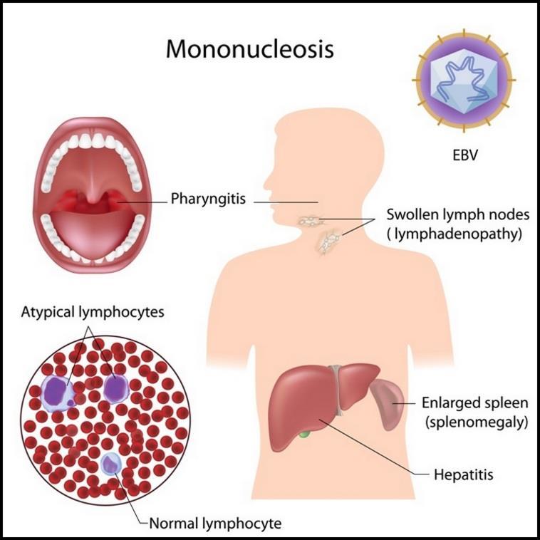 Wirusowe zapalenie wątroby inne wirusy CMV, HIV, EBV, HSV EBV mononukleoza; CMV, HIV