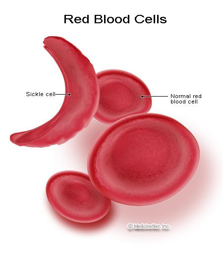 Anemia sierpowata Dobór równoważący faworyzuje heterozygoty gdy: w
