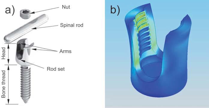 Improving of transpedicular stabilization using SGL Self Guided Lock procedure 123 The problem of resistance to breaking and bending of the screw s threaded part is difficult to solve.