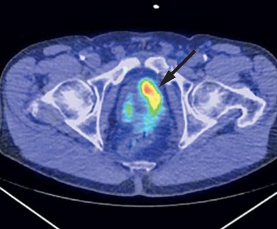 Pozytonowa tomografia emisyjna Obecnie najczęściej wykorzystuje się urządzenia hybrydowe PET+CT lub PET+MRI: Obraz PET+CT rak