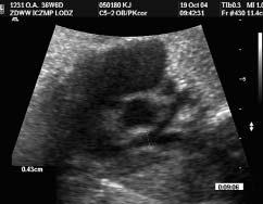 Digoxin was administered transplacentally for 33 days and, additionally, 30 min. oxygen was provided by mask for pregnant woman, 3 times per day.