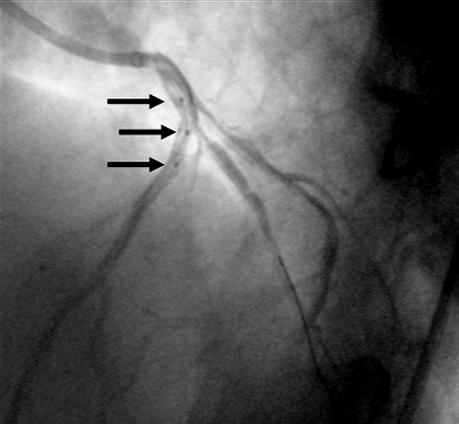 implantacji. Widoczne 3 markery (strza³ki). Marker œrodkowy wskazuje miejsce wyjœcia prowadnika do bocznicy. Powinien siê on znajdowaæ nieco dystalnie do bifurkacji c) inflacja.