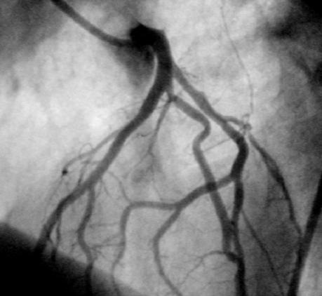 The patient underwent the procedure in the setting of acute coronary syndrome cy mamy sytuacjê, w której balon g³ówny znajduje siê na krótkim prowadniku w naczyniu g³ównym (w systemie monorail), a
