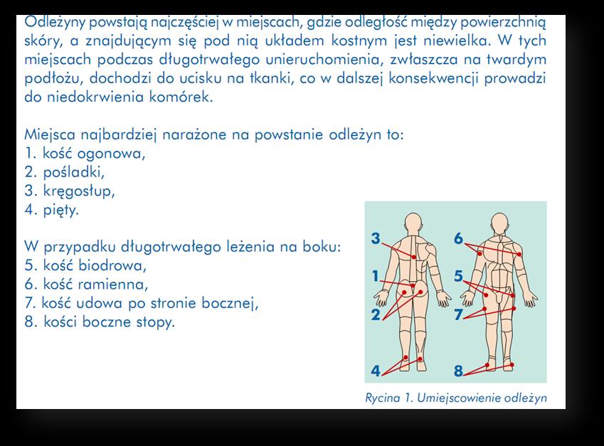 3. Gdzie najczęściej występują odleżyny? 4.