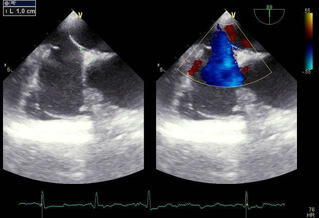 ANN. ACAD. MED. SILES. (online) 2016; 70: 250 255 Ryc. 2. Echokardiogram przezprzełykowy, projekcja przezprzełykowa czterojamowa.