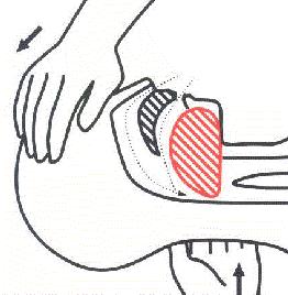 INSTRUKCJA Strona : 62/75 - stopniowe narastanie sinicy twarzy i paznokci spowodowane brakiem lub niedoborem tlenu we krwi, - brak szmerów oddechowych i gwałtowne ruchy oddechowe wskazują na zatkanie