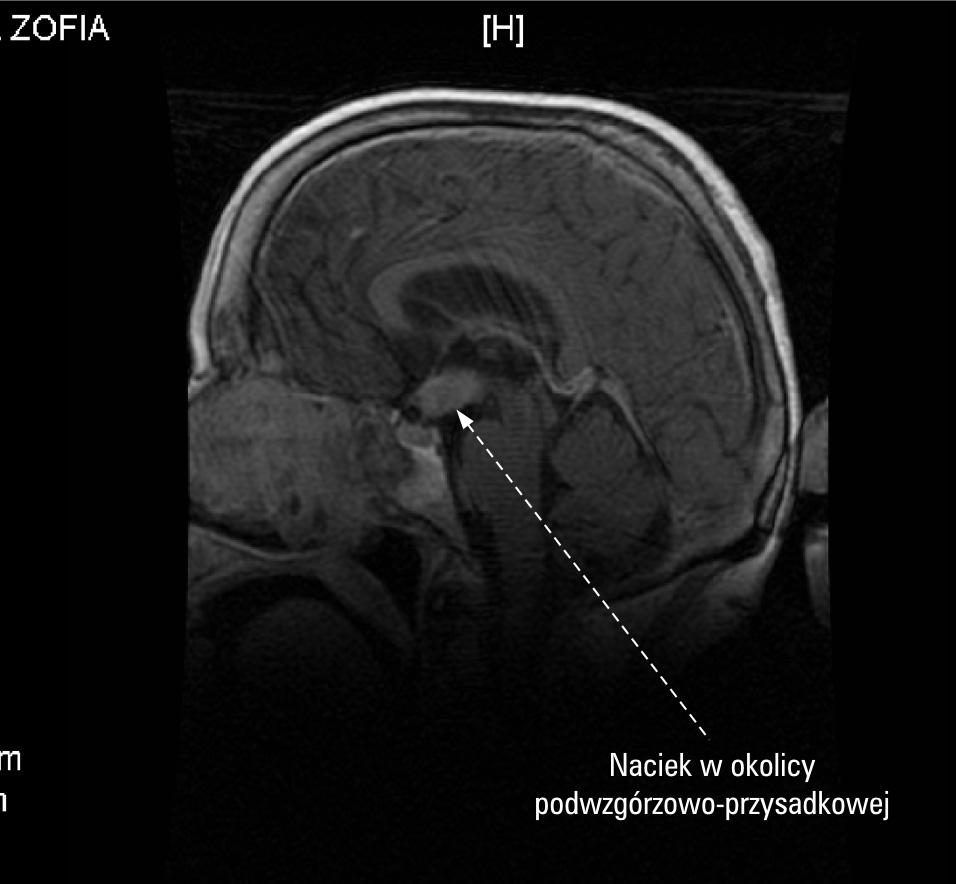 Endokrynologia Polska/Polish Journal of Endocrinology 2006; 6 (57) Opis przypadku Chora, w wieku 69 lat, została przyjęta do Kliniki Endokrynologii, Przemiany Materii i Chorób Wewnętrznych Akademii