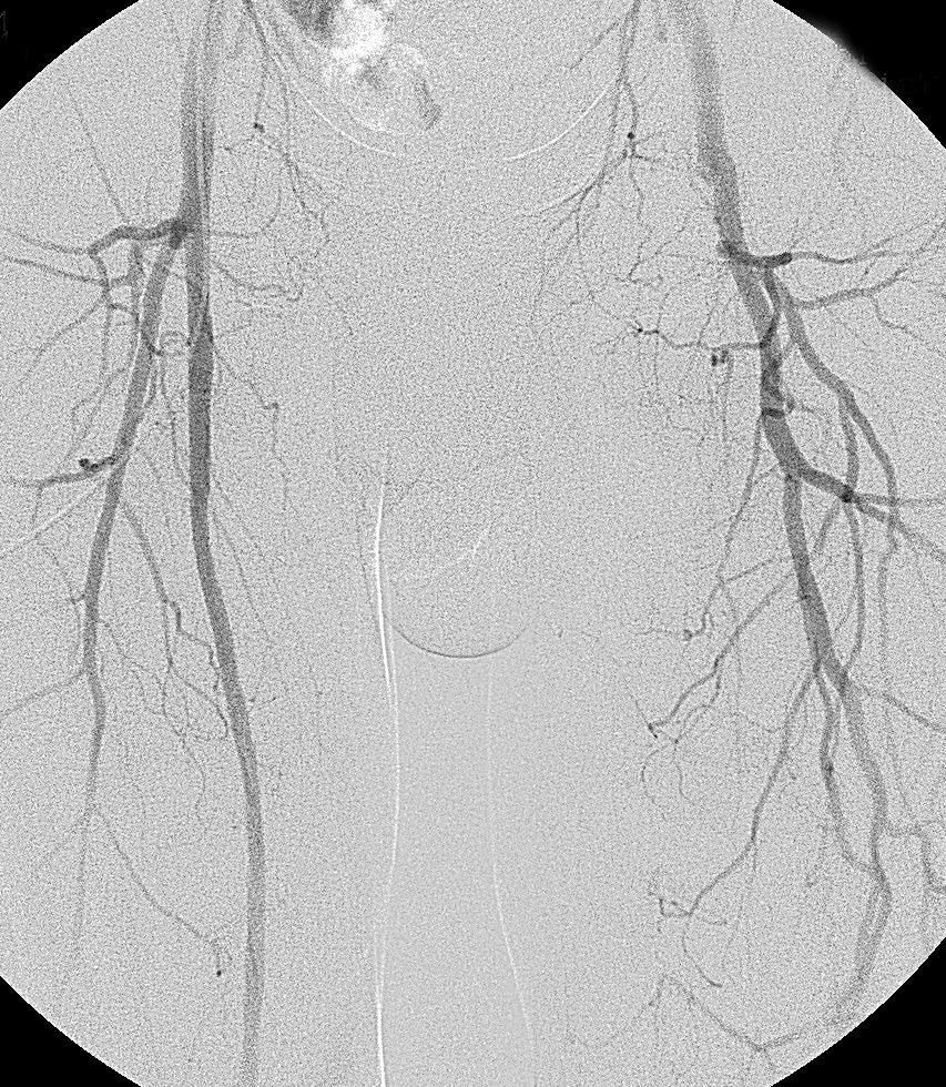Left extremity patent popliteal artery with its bifurcation Rycina 1. Badanie DSA i.a. A. Aorta brzuszna oraz obustronnie układy tętnic biodrowych drożne, ze swobodnym przepływem krwi. B. Po stronie lewej drożne tętnica udowa wspólna oraz tętnica głęboka uda.