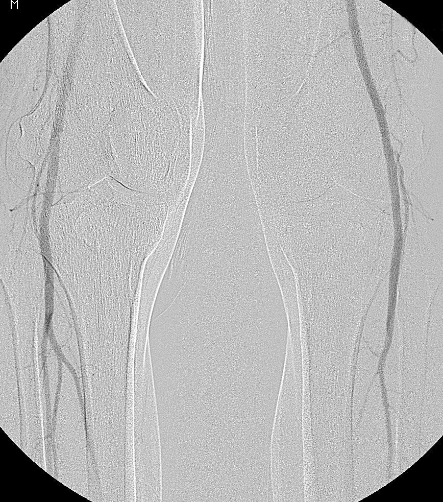 training regimen by the patients. Statistical analysis of the results was performed separately for each leg. Results Analysis was performed in 4 groups depending on the ABI value.