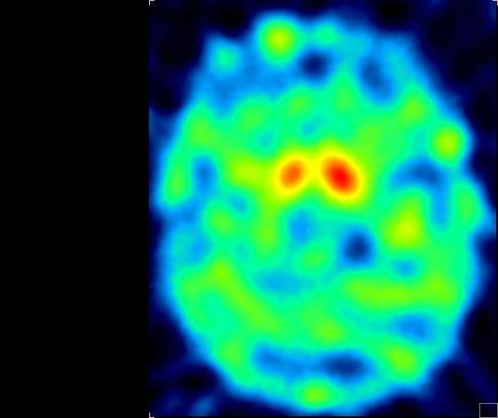 atypowych zespołów parkinsonowskich Może być przydatne w różnicowaniu chp z parkinsonizmem polekowym, psychogennym, naczyniopochodnym lub