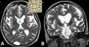 PARKINSONIZM ATYPOWY W MR MSA-C: objaw krzyża w rzucie