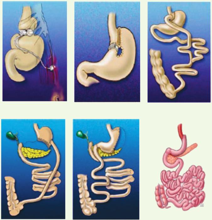 AGB VGB RYGB BPD BDP DS SG Rycina 1. Metody chirurgii bariatrycznej Źródło: Mechanick J.I., Kushner R.F., Sugerman H.J. i wsp. AACE/TOS/ASMBS Guidelines. Obesity 2009; 17 (supl. 1): 4 i trzustkowego.