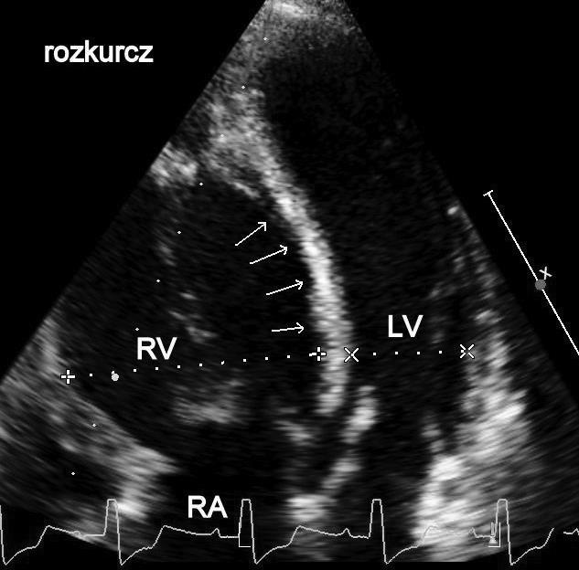 Heart J 2015 doi:10.