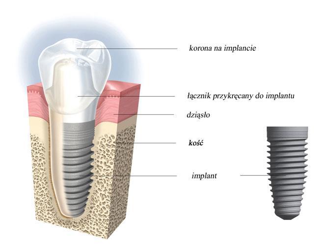 Implantologia-systemy implantologiczne (rodzaje implantów) Implant MIS Seven lub M4 2500 zł plus cena korony* Implant MIS C1 3000 zł plus cena korony* Implant MIS V3 3500 zł plus cena korony* *