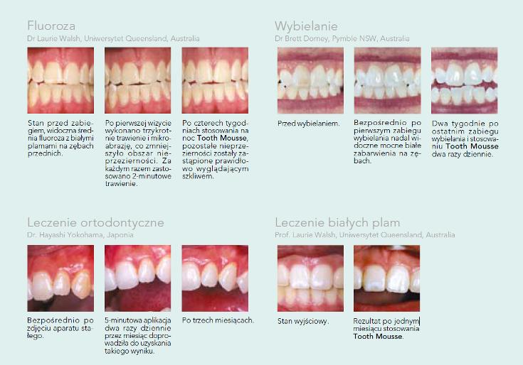 - Po profesjonalnym oczyszczaniu zębów. - Po miejscowym zastosowaniu fluoru (fluoryzacji). - Podczas lub po leczeniu ortodontycznym. W szczególności białe plamy.