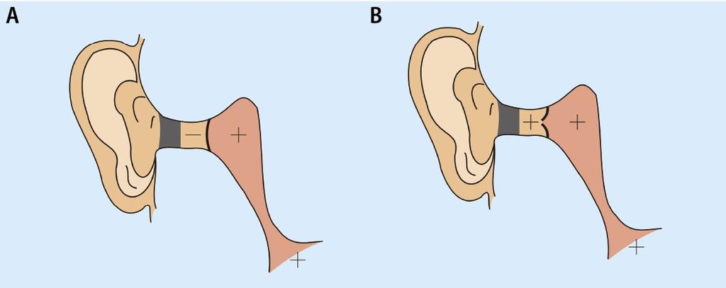 Uraz ciśnieniowy ucha I grupa chorób Objawy urazu ciśnieniowego uszu Uraz ciśnieniowy uszu podczas zanurzania Podczas nurkowania z niedrożnym przewodem słuchowym zewnętrznym, jeżeli nurkujący ma