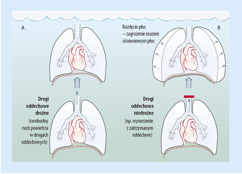 Uraz ciśnieniowy płuc I grupa chorób Przyczyny urazu ciśnieniowego płuc Do najczęstszych przyczyn urazu ciśnieniowego płuc należą: wynurzanie z zatrzymanym oddechem podczas nurkowania z nurkowym