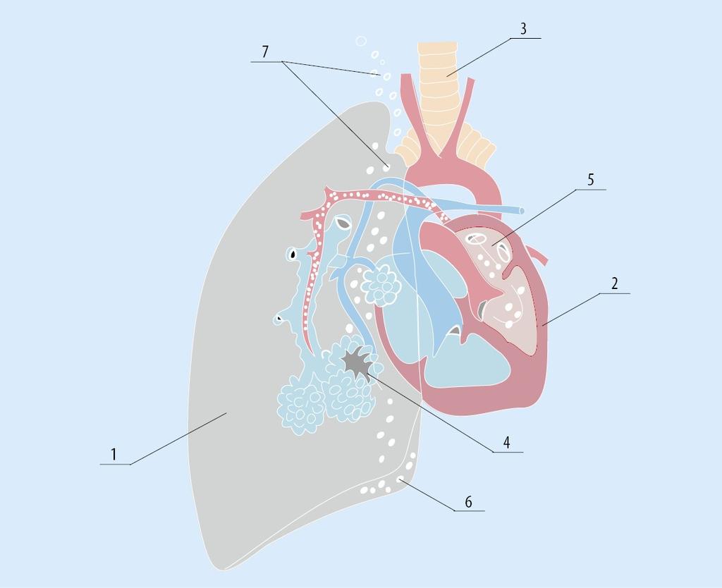 Droga powietrza z uszkodzonych pęcherzyków płucnych w obrębie klatki piersiowej: 1 płuco, 2 serce, 3 tchawica, 4 uszkodzony pęcherzyk płucny, 5 pęcherzyki powietrza w lewym przedsionku serca, 6