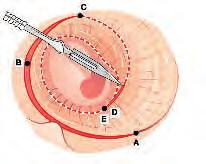10 Chirurgia Kości Skroniowej Wytyczne z Zurychu C 14a 14b 15a 15b Płat Skóry Przewodu Uwidocznienie całej błony bębenkowej przy jednym ustawieniu mikroskopu jest możliwe dzięki wytworzeniu dużego
