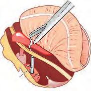 Chirurgia Kości Skroniowej Wytyczne z Zurychu 31 Wykonanie Otworu w Podstawie Strzemiączka Etap ten wykonuje się ręcznymi perforatorami jak w incudostapedotomii.