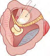 36 Chirurgia Kości Skroniowej Wytyczne z Zurychu Folia Silastic Powięź mięśnia skroniowego 73a 73b Gdy brakuje błony bębenkowej, do ucha