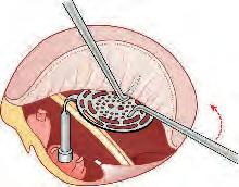 Chirurgia Kości Skroniowej Wytyczne z Zurychu 39 79a 79b Obrót Głowy FTTP pod Błoną Bębenkową Bucik FTTP jest umocowany w środkowej części podstawy