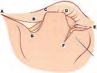 Powiększenie Kostnego PSZ Tylną ścianę kostnego przewodu słuchowego powiększa się wiertłem diamentowym (ryc.