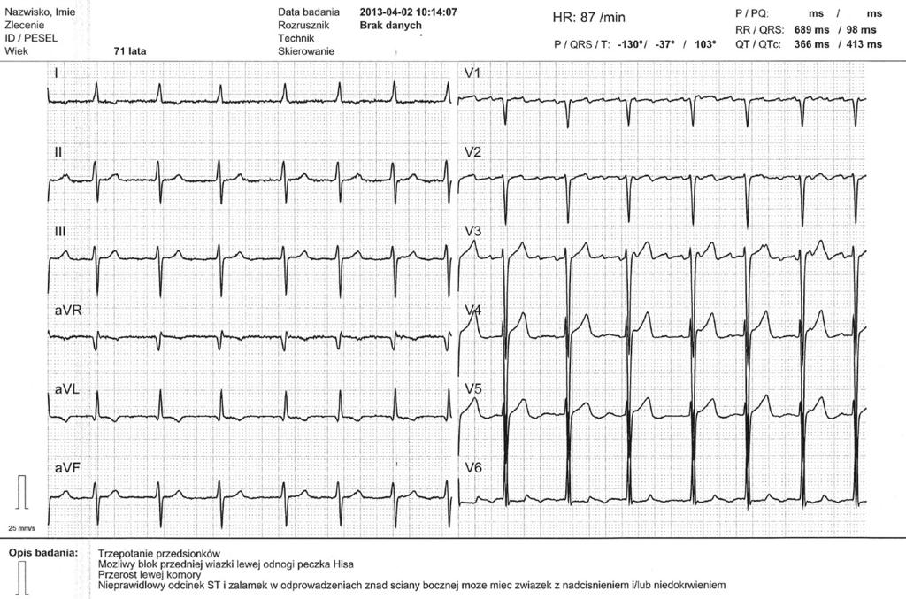 W tym przypadku tryb automatyczny nie poradził sobie z oceną rytmu prowadzącego. Załamki P rytmu zatokowego (bradykardia zatokowa) są doskonale widoczne.