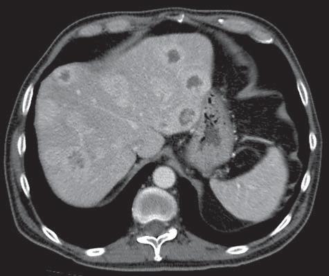 Liczne zmiany przerzutowe w wątrobie, stan po operacji guza pierwotnego jelita cienkiego. Standardowy obraz badania CT, projekcja poprzeczna, a faza tętnicza badania oraz b faza wrotna.