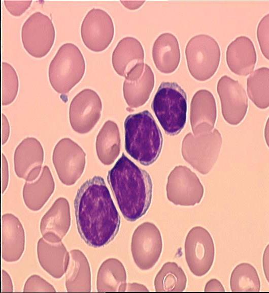 B-CLL Morfologia: Małe limfocyty z niewielkim rąbkiem cytoplazmy i ze zbitą chromatyną zbitą w grudy, bez jąderek.