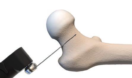 łoża implantu wzdłuż łuku Adamsa. Otworzyć kanał szpikowy w pobliżu przyśrodkowej korówki ręcznie przy użyciu raszpli otwierającej.