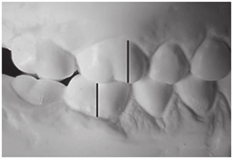The role of permanent first molar relationship in assessing class II 49 Criteria of excluding the material from the study were as follows: 1. previously conducted orthodontic treatment, 2.