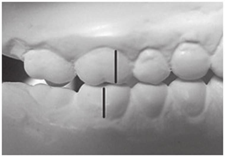 One hundred and fifty cast models of patients dentition were selected, comprising those of 89 female and 61 male patients.