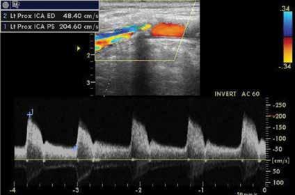 Julitta Okrój-Lubecka i wsp. Metody neuroobrazowania ostrej fazy Tabela 1 Klasyfikacja TIBI (Trombolysis in Brain Ischemia) według Demchuk i wsp.