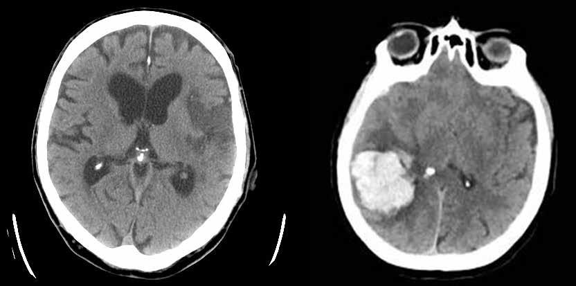 po wystąpieniu objawów): badanie CT głowy nie wykazało obszaru niedokrwienia (A); w wykonanym badaniu MRI w sekwencji DWI stwierdzono obszar hiperintensywny (B) B B TOMOGRAFIA KOMPUTEROWA (CT)