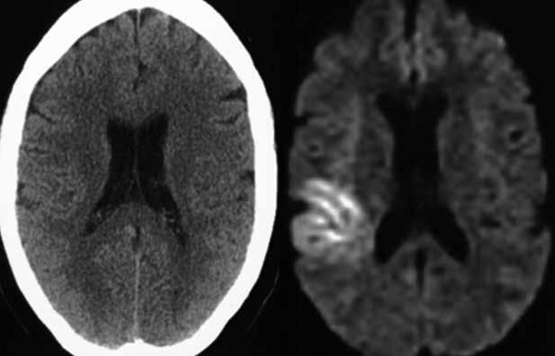 przeglądowa CT) jest metodą stosowaną rutynowo w rozpoznawaniu wczesnej fazy udaru mózgu i jest jedynym badaniem radiologicznym wymaganym w standardach opisujących zasady kwalifikacji pacjenta do