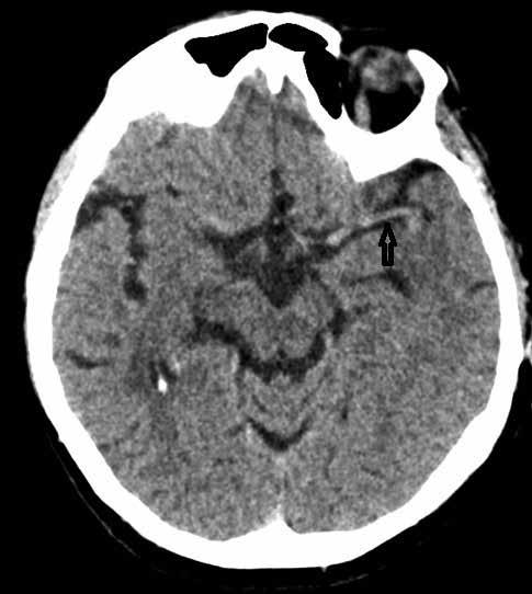 Julitta Okrój-Lubecka i wsp. Metody neuroobrazowania ostrej fazy Rycina 4. Objaw hiperdensyjnej tętnicy środkowej mózgu lewej w obrazie CT mózgowia Rycina 6.