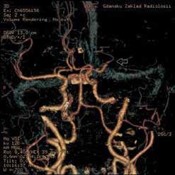 mózgu (M1-M6) cyzyjną lokalizację niedrożności lub zwężenia naczynia krwionośnego oraz wykrycie dróg krążenia obocznego (ryc. 6).