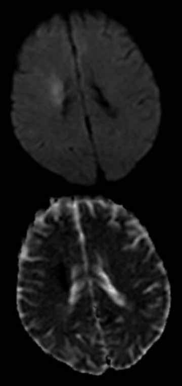 A Rycina 11. Niedrożność szczytu tętnicy podstawnej mózgu w badaniu angio-mr (brak przepływu w tętnicach mózgu tylnych) B Rycina 10.