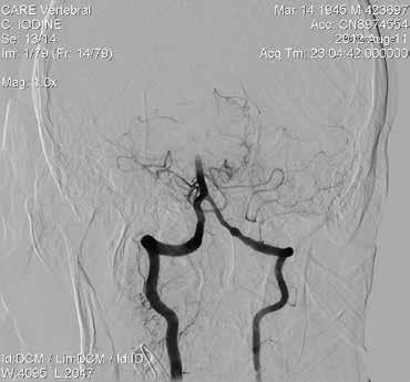 Rycina 13. Cyfrowa angiografia subtrakcyjna ukazująca okluzję szczytu tętnicy podstawnej mózgu A B A Rycina 14.